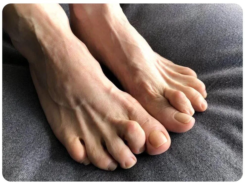 Красивые пальцы ног. Сильные пальцы ног. Молоткообразные деформации пальцев. Сильные пальцы ног. Молоткообразные пальцы стопы.