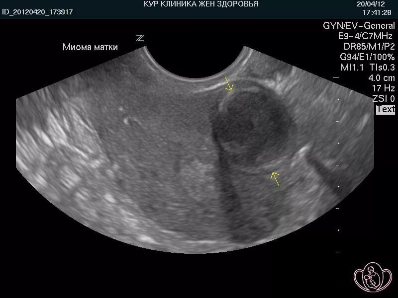 Интрамуральная миома матки УЗИ. Интрамуральная миома на УЗИ. Интрамуральный миоматозный узел. Шеечный миоматозный узел.
