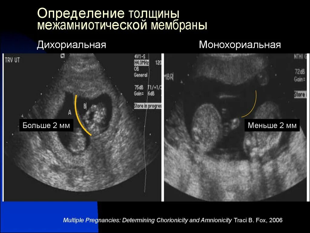 Что значит монохориальная двойня. Монохориальная и дихориальная. монохориальная двойня узи. дихориальная диамниотическая двойня узи. монохориальная моноамниотическая двойня узи.