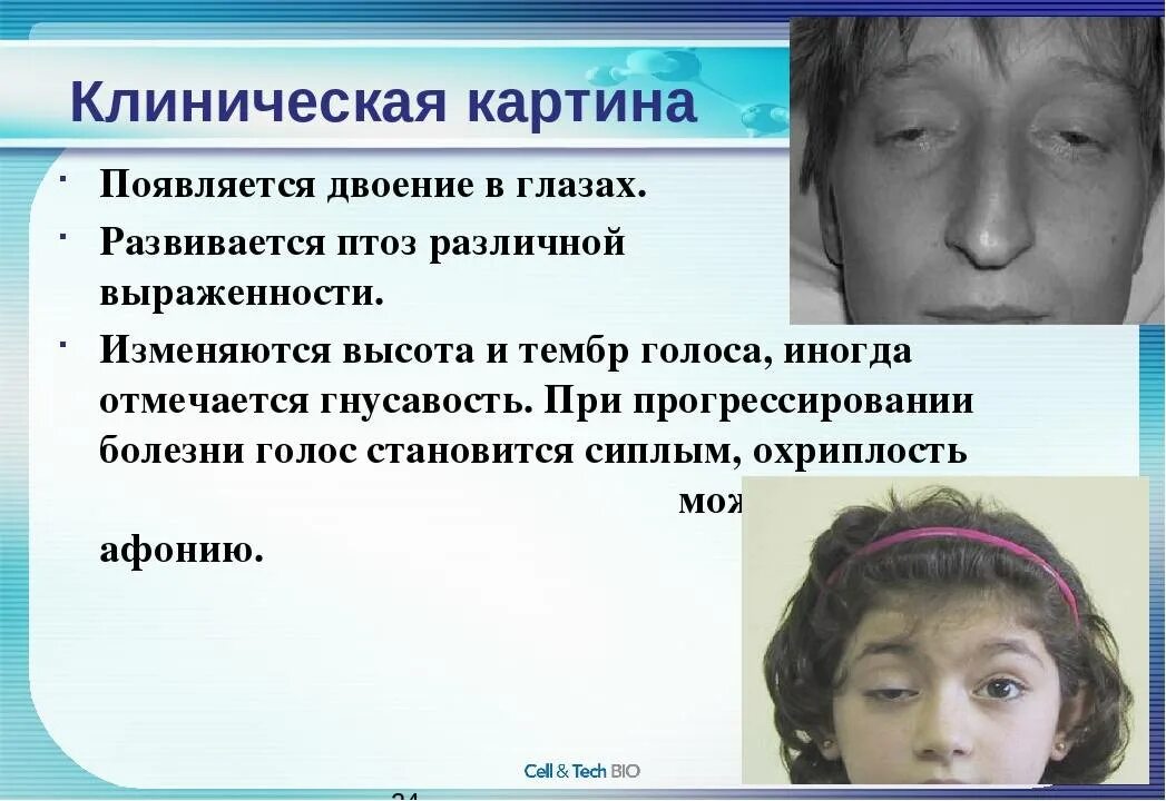 Головокружение двоение в глазах. Двоение в глазах причины. Нарушение зрения диплопия. Двоение в глазах диплопия. Диплопия клинические проявления.