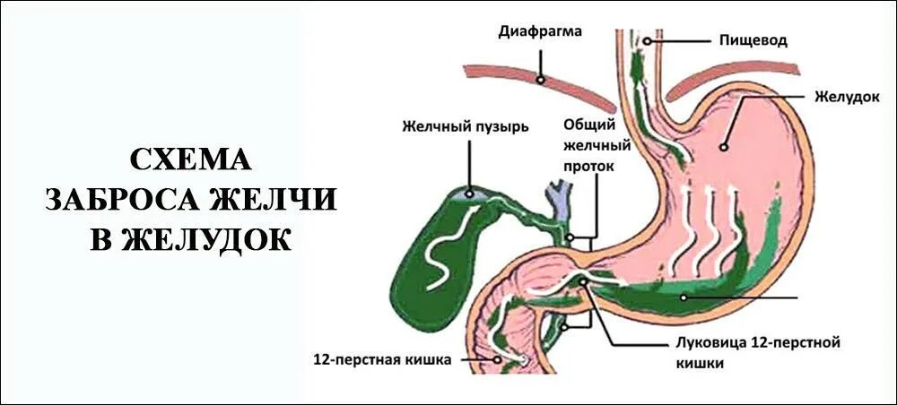 Рефлюкс заброс. Одди сфинктер гастрит рефлюкс. Заброс желчи в желчный пузырь. Дуодено-гастральный рефлюкс желчи. Дуодено-гастральный желчный рефлюкс.