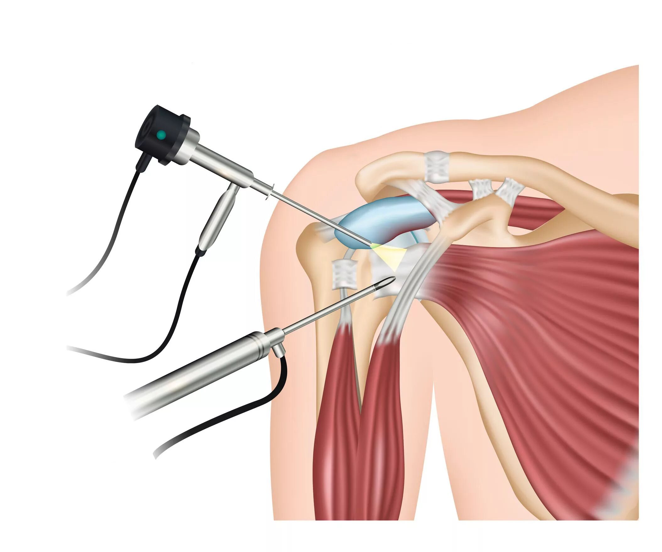 Плечо артроскопии плечевого сустава. Артроскопическая операция плечевого сустава. Бурсит плечевого сустава операция. Артроскопическая декомпрессия плечевого сустава. После операции болят плечи