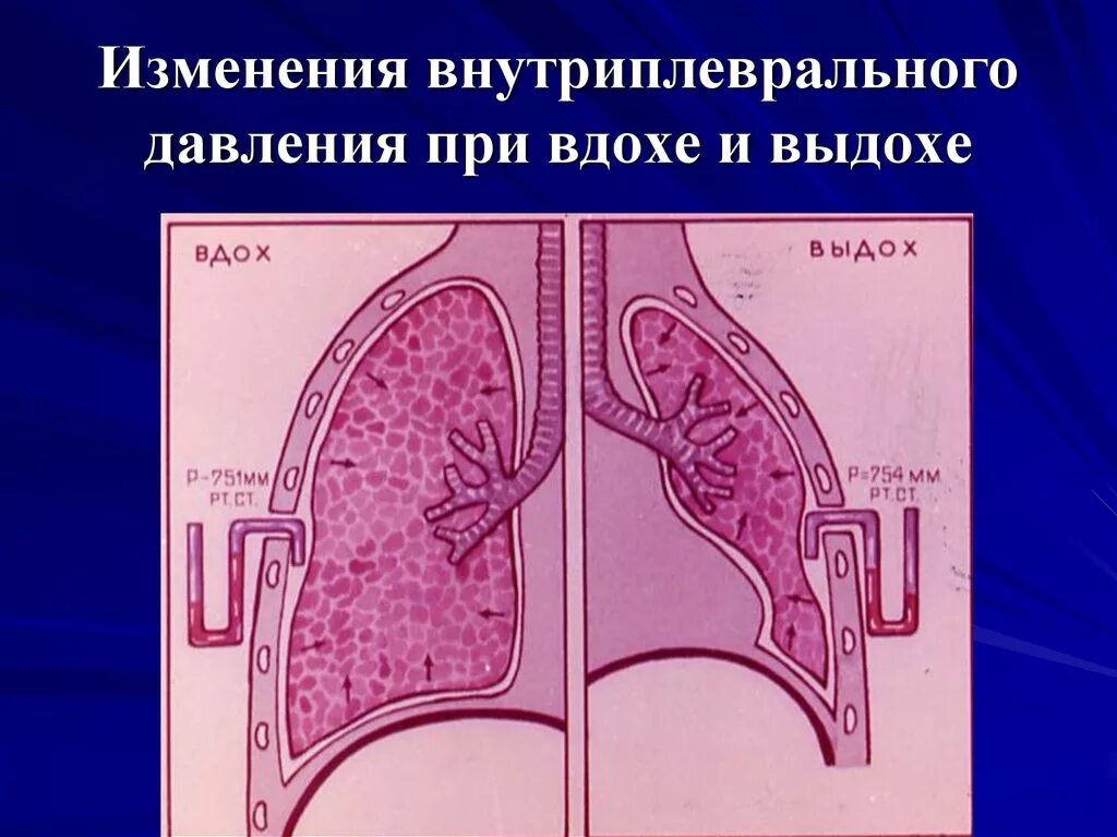 Внутриплевральное давление при вдохе и выдохе. Давление в плевральной полости. Изменение внутриплеврального давления при вдохе и выдохе. Внутриплевральное давление при выдохе. Звук в легких при дыхании