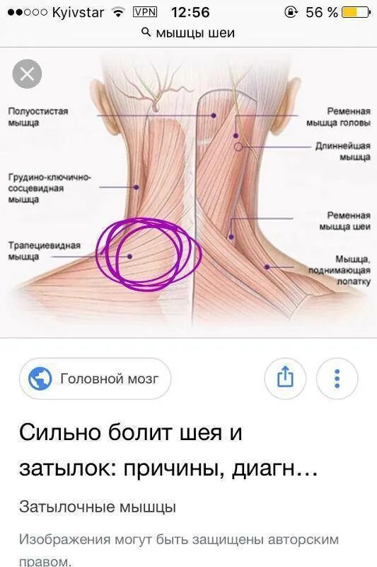 Скрип в голове. Болит затылок, шея не поворачивается.