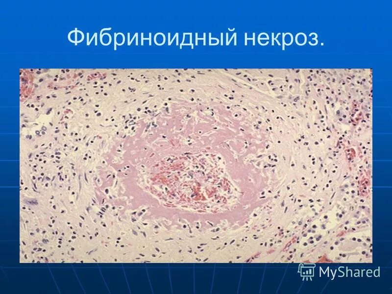 патологическая анатомия мукоидное набухание фибриноидное. фибриноидное набухание и некроз соединительной ткани при ревматизме. коагуляционный некроз гистология. причины фибриноидного некроза. фибриноидный некроз стенки сосуда.