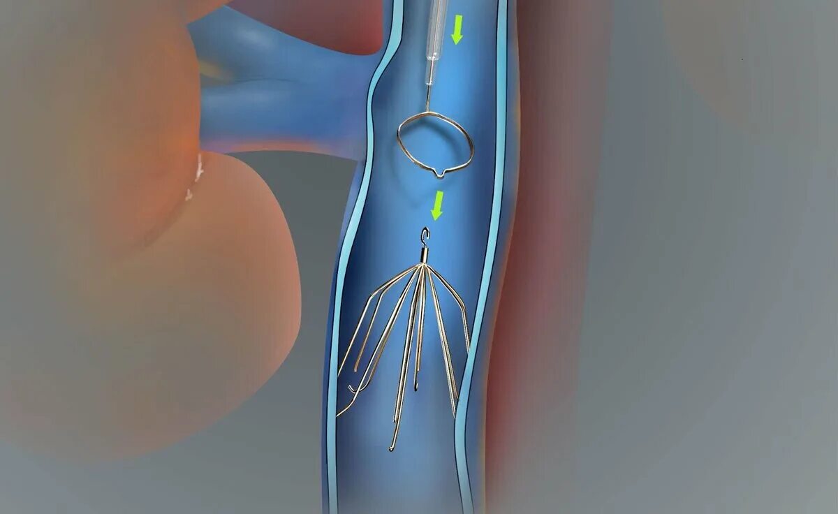 Кава фильтр в нижней полой Вене. Реолитическая катетерная тромбэктомия. Эндоваскулярная аспирационная тромбэктомия. Чрескожная аспирационная тромбэктомия. Сколько стоит тромба