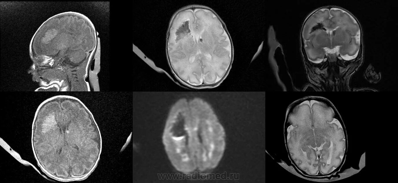 Мрт мозга опасно. Мрт головного мозга у новорожденного в норме. Кт головного мозга новорожденного норма. Мрт головного мозга у детей норма.