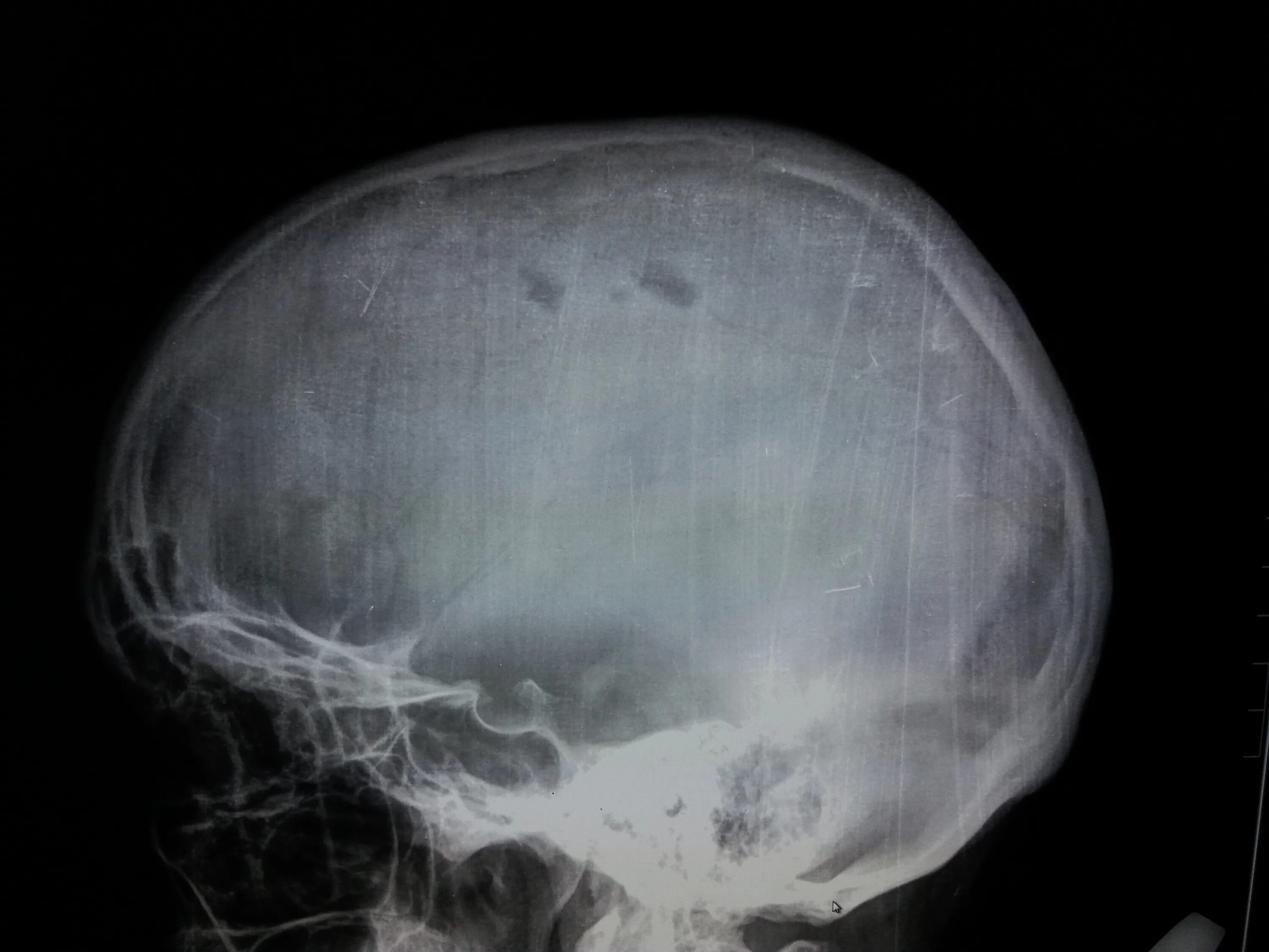 Кости черепа рентген. Остеома теменной кости. Перелом свода черепа кт. Лобная рентгенограмма черепа.