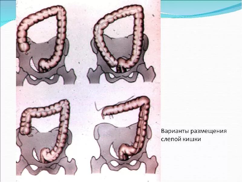 Развитие аппендикса. Аномальное расположение аппендикса. Варианты размещения слепой кишки.