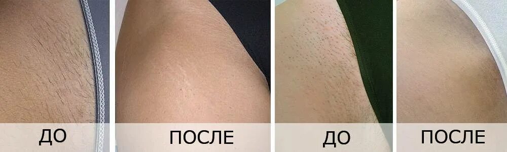 С какого возраста делать лазерную эпиляцию
