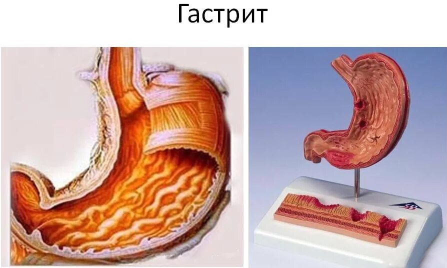 Гастрит 2 стадии. Хронический гастрит и язвенная болезнь. Острый гастрит гастродуоденит. Хронический гастрит желудок.