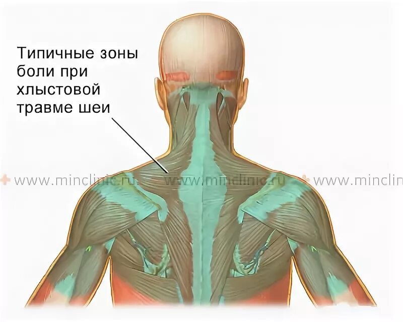 Ударился затылком болит. Шейно-черепной синдром м53.0 что это.