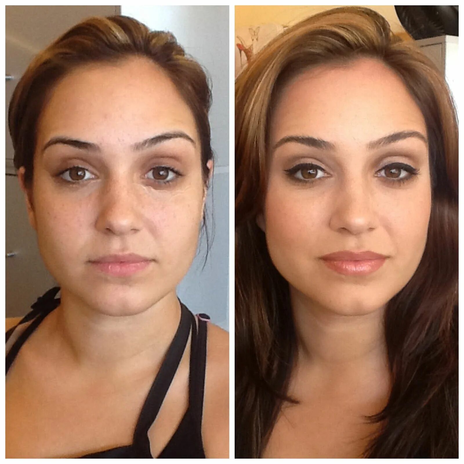 Cheek Fillers How Much Cheek fillers, Cheek implants, Lip fillers
