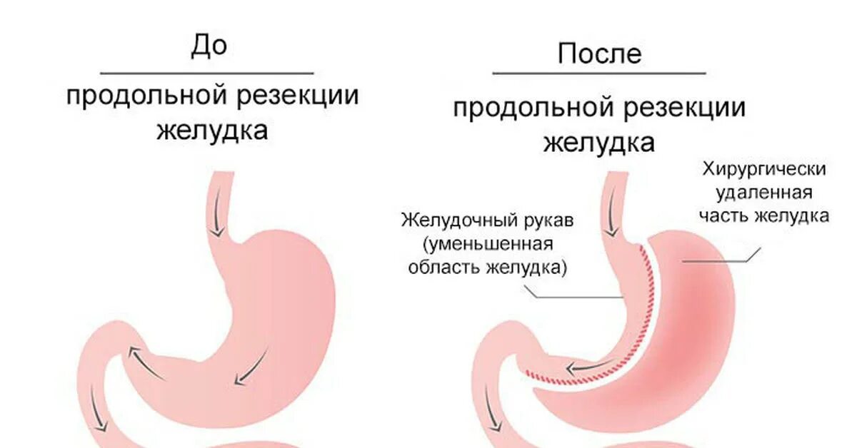 Бариатрическая продольная резекция желудка. Продольная (рукавная) резекция желудка. Калибровочный зонд для продольной резекции желудка. Без желудка после операции