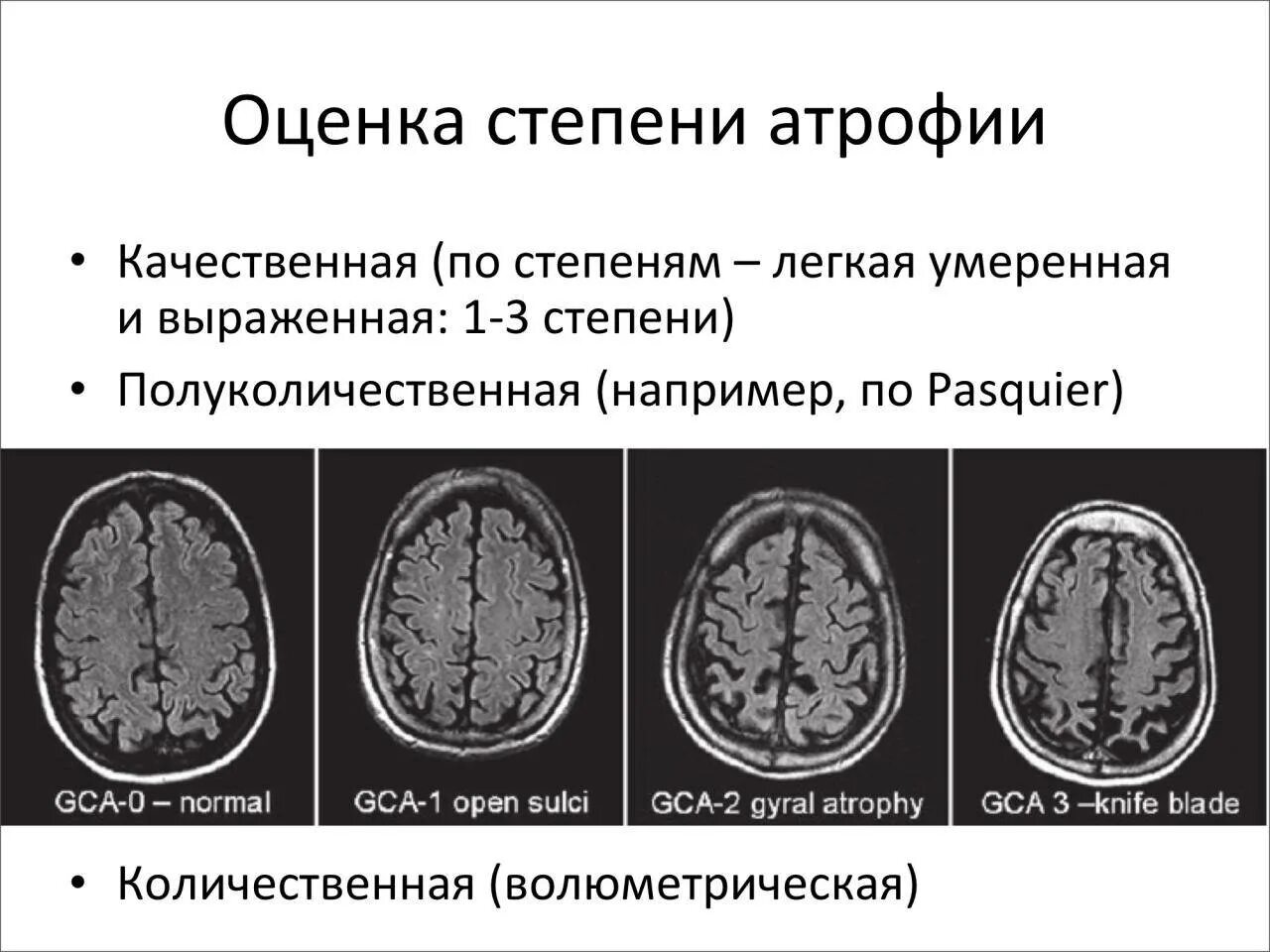 Атрофия головного мозга 1. Наружная внутренняя гидроцефалия мрт. Заместительная наружная гидроцефалия кт. Гидроцефалия головного мозга на кт. Наружная гидроцефалия головного мозга кт.