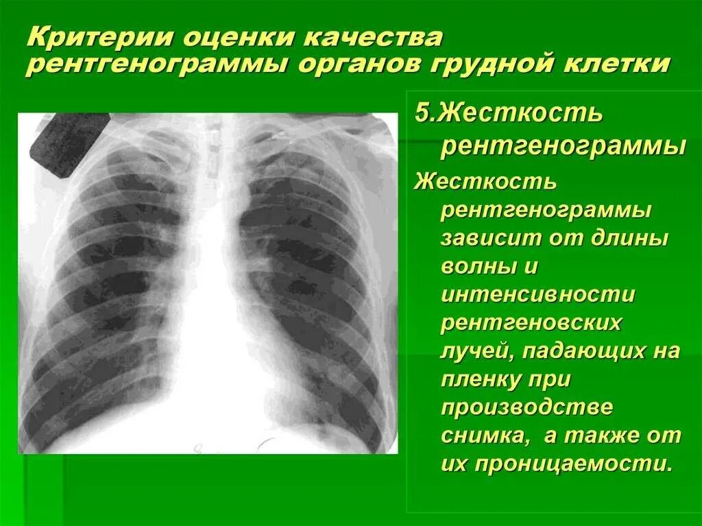 Что показывает рентген. Рентген органов грудной клетки норма и патология. Рентген органов грудной полости норма. Рентген лёгких норма. Рентгенограмма грудной полости.