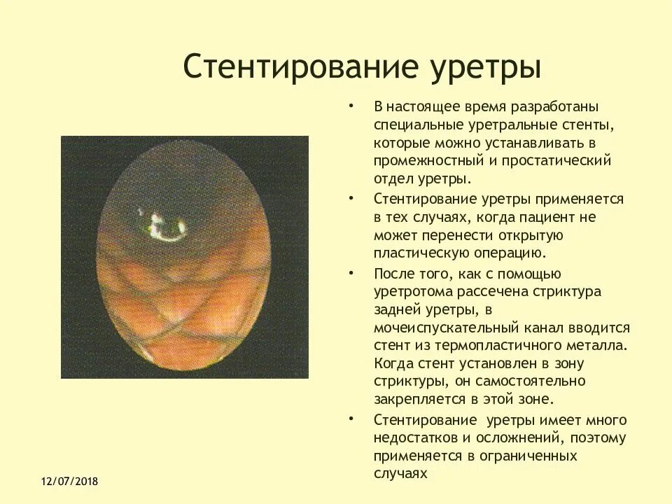 Уретральные стенты. Уретральный простатический стент. Уретральное стентирование.