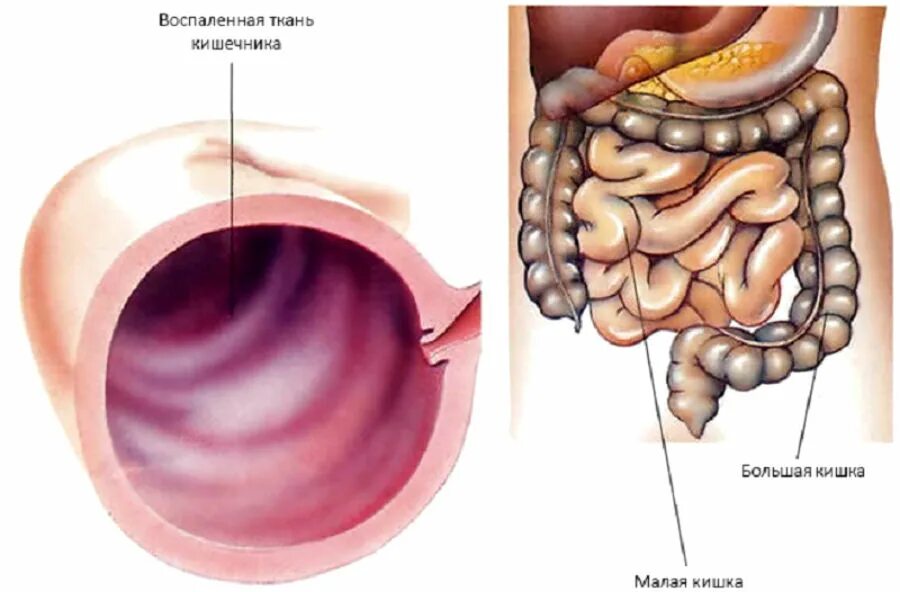 Трещина в кишечнике. Энтерит колит энтероколит. Хронический энтероколит толстой кишки. Хронический энтерит тонкого кишечника. Воспаление кишечника энтерит.