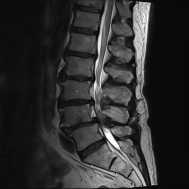 Абсолютный стеноз позвоночного канала мрт. Абсолютный стеноз позвоночника l5 s1. Спинальный стеноз. Стеноз поясничного отдела позвоночника мрт.