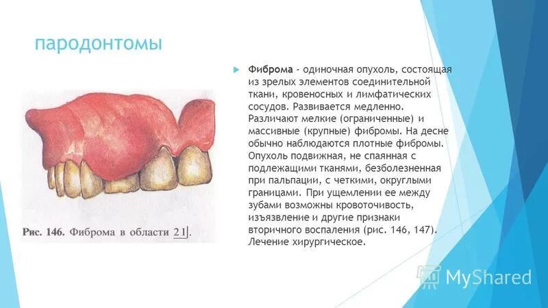 Опухоль подвижна. Новообразование на Десне.