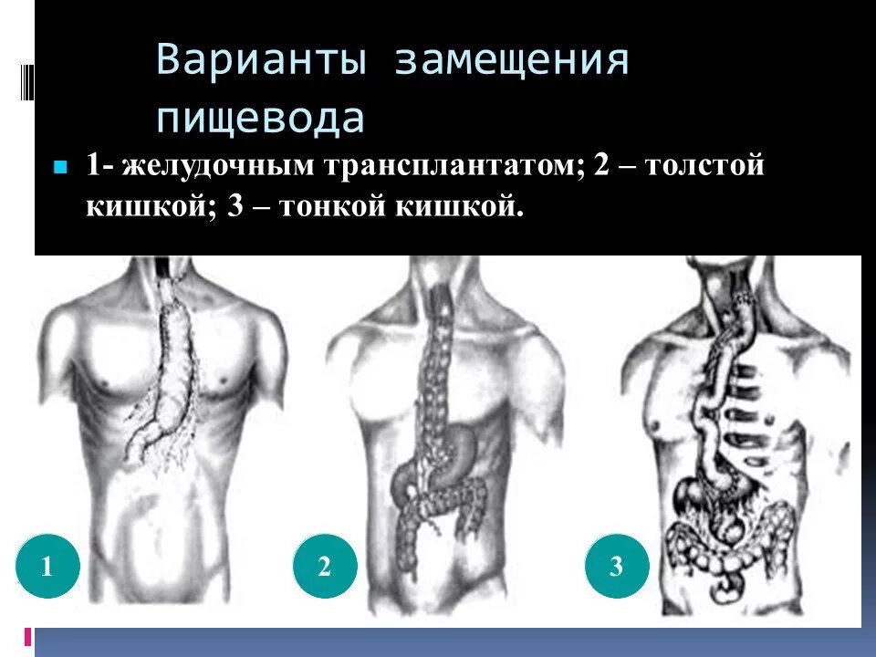 Пластика пищевода желудочным трансплантатом. Методика пластики пищевода. Современные методы пластики пищевода. Резекция пищевода по Тореку Добромыслову.