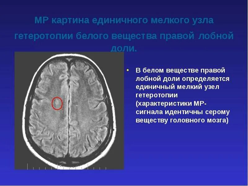 Очаг глиоза в теменной доле. Единичный субкортикальный очаг в правой лобной доле. Белое вещество в правой лобной доле. Очаги в белом веществе лобных долей. Очаг в правой лобной доли.