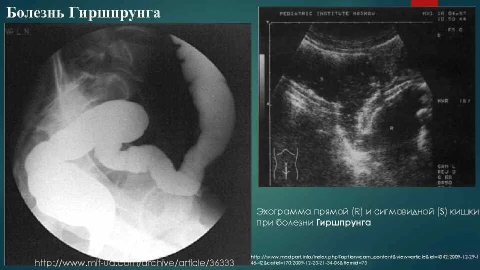 Слепая кишка мкб 10. Гиршпрунга рентген признаки. Болезнь Гиршпрунга УЗИ. УЗИ кишечника при болезни Гиршпрунга. Болезнь Гиршпрунга аноректальная манометрия.
