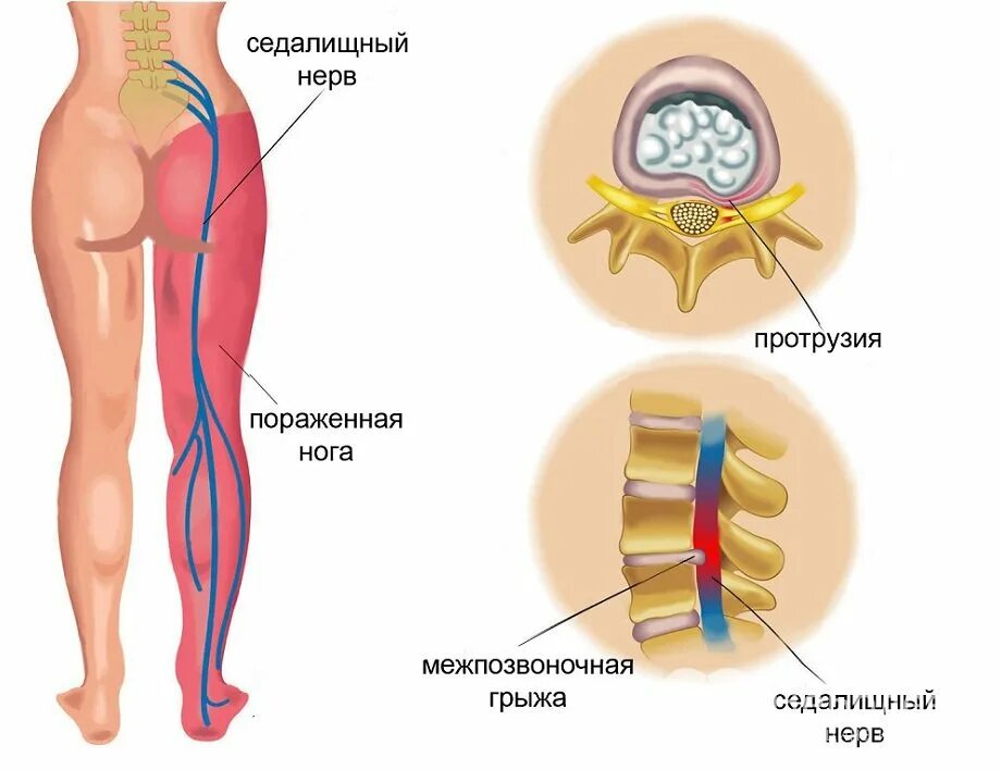 Зажим в пояснице. Седалищный нерв локализация. Воспалился седалищный нерв. Поражение седалищного нерва симптомы.