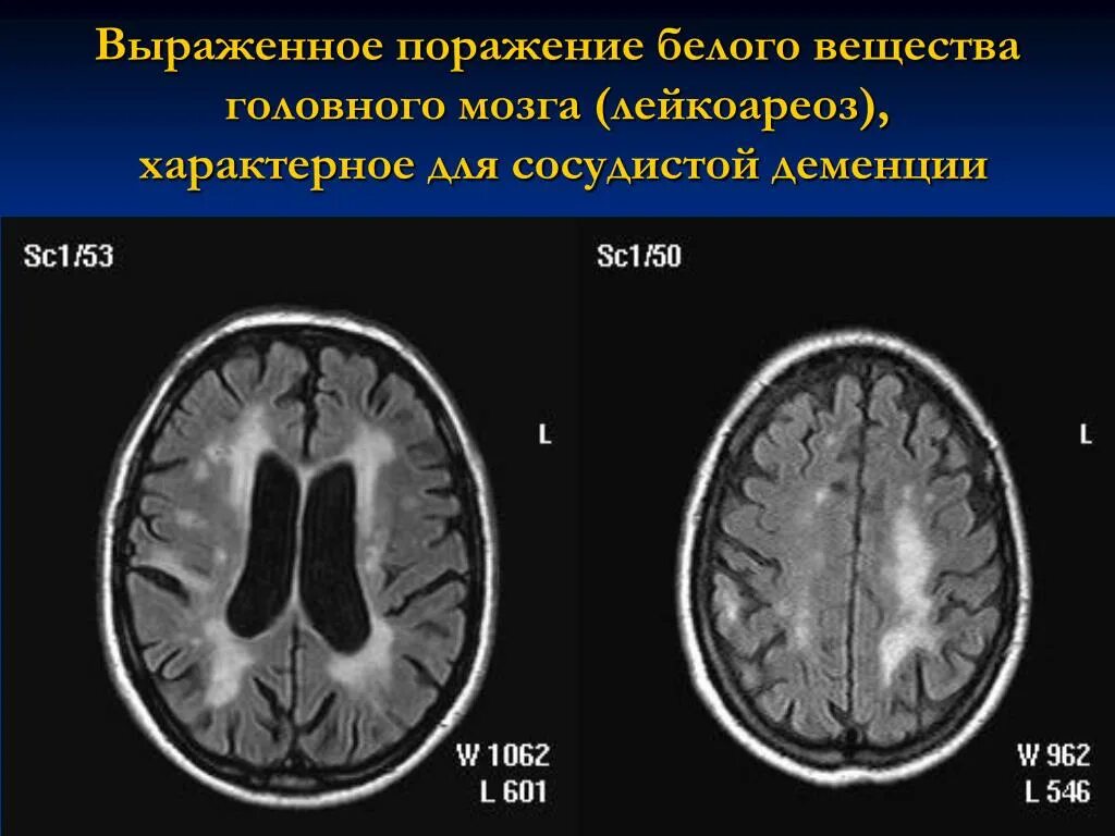 Лейкоареоз на кт. Перивентрикулярный лейкоареоз на кт. Перивентрикулярный лейкоареоз( 1 ст). Хроническая ишемия головного мозга мрт.