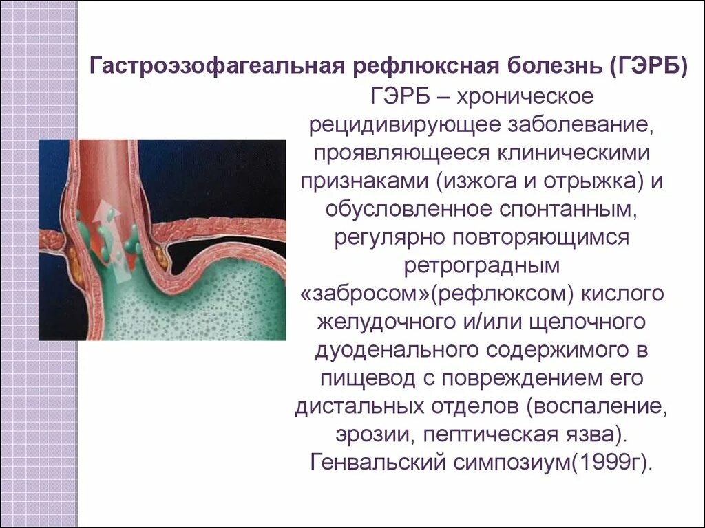 Как убрать рефлюкс. Презентация Гастроэзофагеальная рефлюксная болезнь у детей симптомы. Гастроэзофагеальный (желудочно-пищеводный) рефлюкс. Гастроэзофагеальнорефлюксная болезнь (ГЭРБ);. Эзофагеальная болезнь ( рефлюкс).