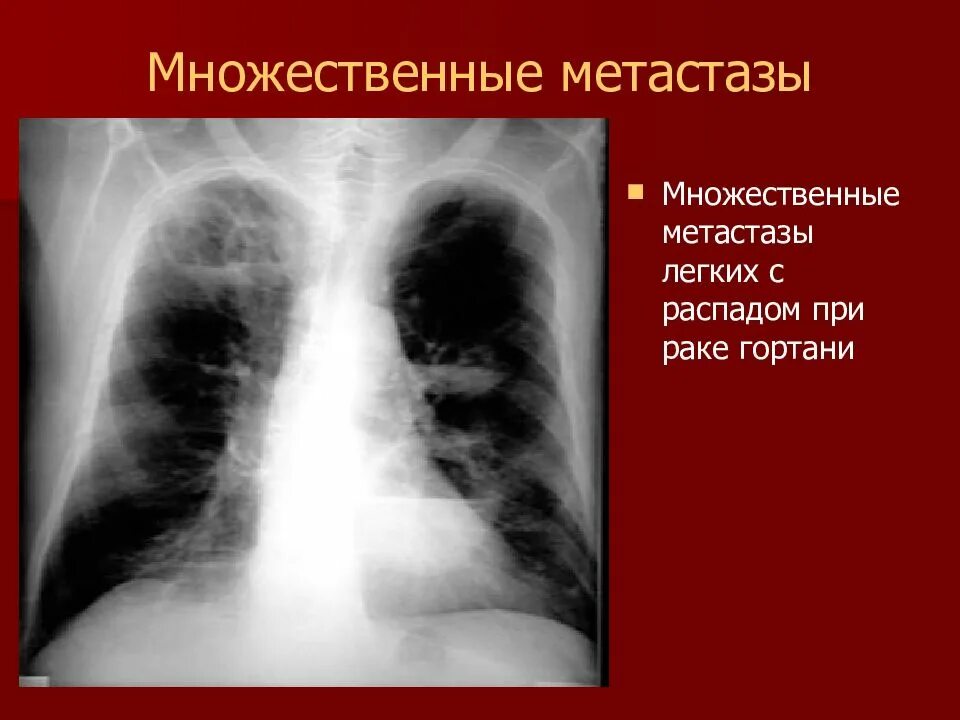 Рентгенодиагностика опухолей легких. Опухоль с распадом на рентгене. Признаки метастаз в легких