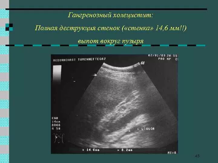 Изменение стенок желчного пузыря. Острый калькулезный холецистит на УЗИ. Гиперэхогенный желчный пузырь УЗИ. Перивезикальный инфильтрат желчного. Острый холецистит УЗИ картина.