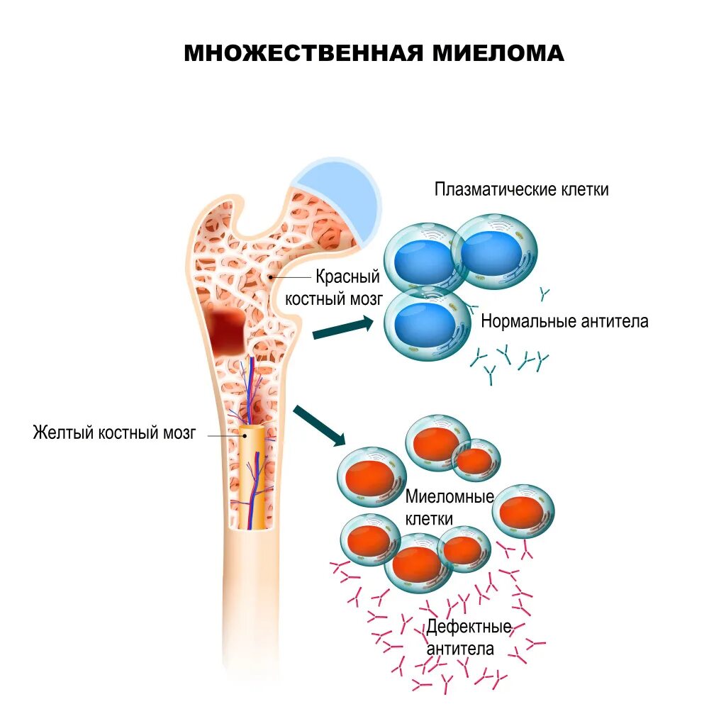 Костный мозг какие заболевания. Миеломная болезнь костный мозг. Миеломная болезнь костного мозга симптомы. Бессимптомная миелома. Полиморфноклеточная миелома.