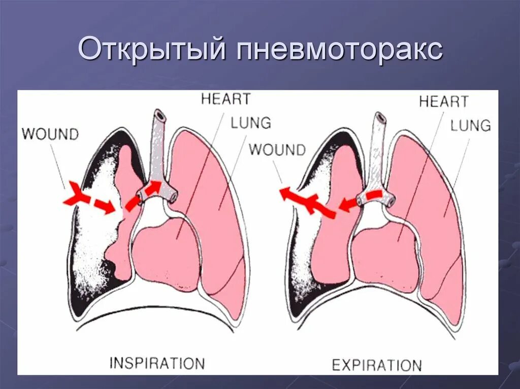 Ранение в грудную клетку пневмоторакс. Открытый и клапанный пневмоторакс. Открытый и закрытый пневмоторакс. Закрытый пневмоторакс.