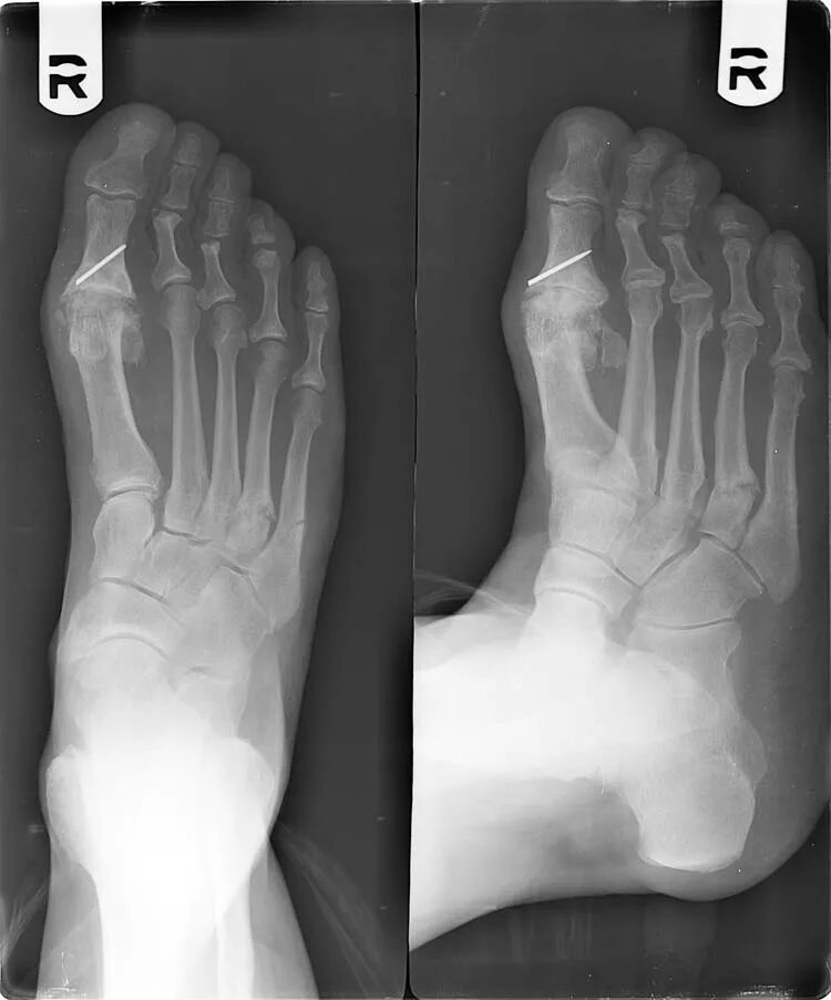 Как определить трещину в кости. Остеосинтез плюсневой кости спицами. Сесамовидная кость стопы перелом. Перелом плюсны мизинца. Остеосинтез фаланги пальца стопы.