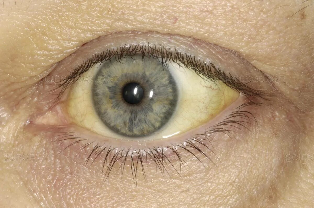 Бледно желтые глаза. Птеригиум, ксантелазма. Пожелтение склер гепатит. Иктеричность кожных склер.