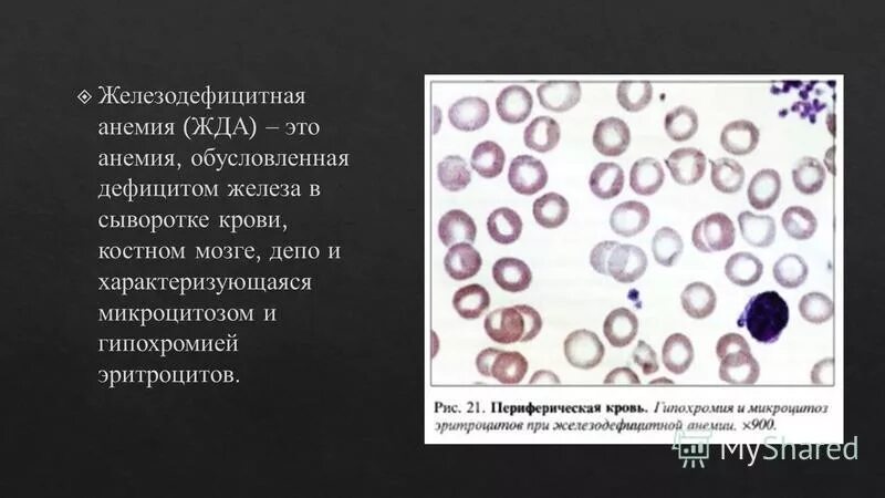 Дефицит железа мкб 10. Костномозговое кроветворение при железодефицитной анемии. изменения костного мозга при железодефицитной анемии. железодефицитная анемия морфология.
