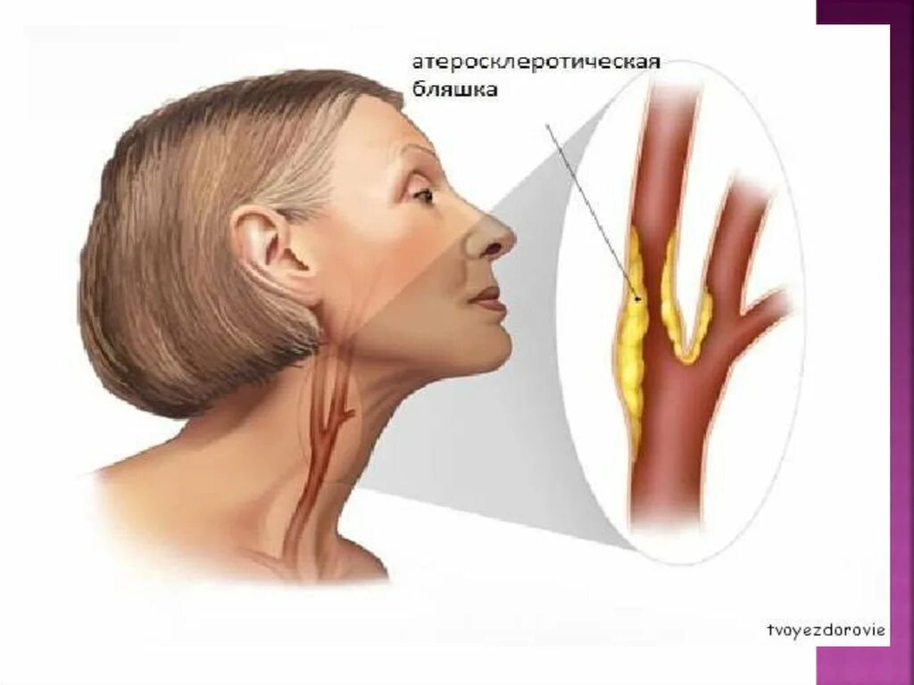 Атеросклеротическая бляшка в сонной артерии. Атеросклероз сосудов брахиоцефальных артерий. Бляшка сонной ар терииэ. Холестериновая бляшка в сонной артерии. Бляшка на шее операция