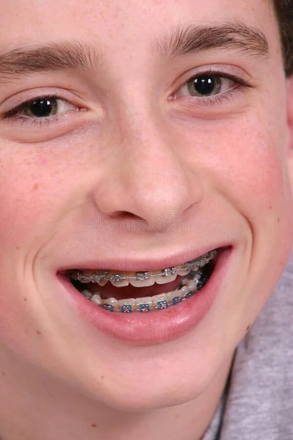 Зубы подростка фото 1,231 Smiling Teen Orthodontic Braces Stock Photos Free & Royalty-Free Stock P