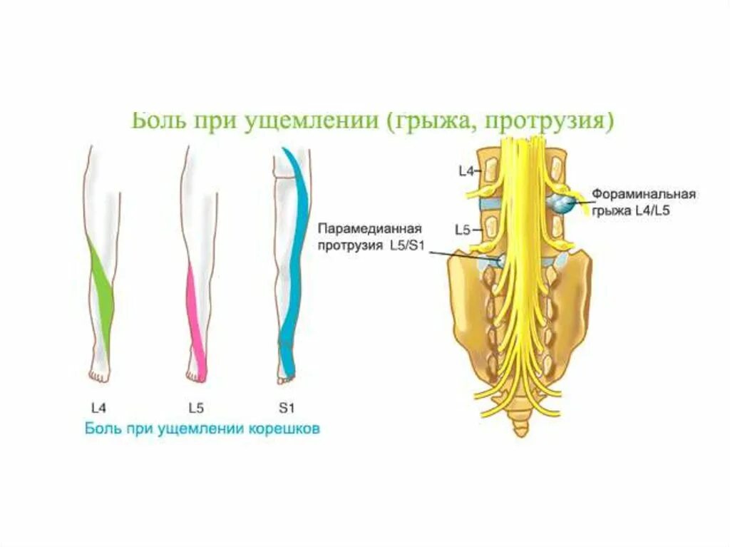 Корешки поясницы. Иннервация Корешков поясничного отдела. Корешок l4-l5. Синдром компрессии корешка l5. Корешок с5 иннервация.