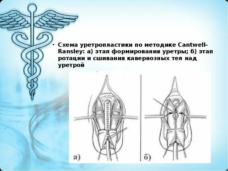 Эписпадия. Операции при эписпадии. Расщепление уретры у мальчиков. Операция при гипоспадии.