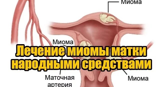 Как лечить миому матки без операции. Миома матки народные средства. миома матки лечение народным средством. народные средства при миоме матки. лечение миомы матки народными способами.