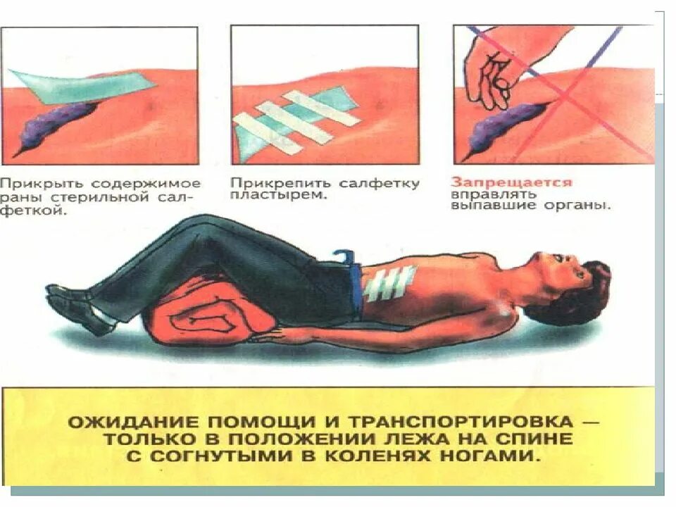 Признаки внутреннего кровотечения оказание помощи. Внутреннее кровотечение первая помощь. Положение человека при внутреннем кровотечении. Положение больного при внутреннем кровотечении.