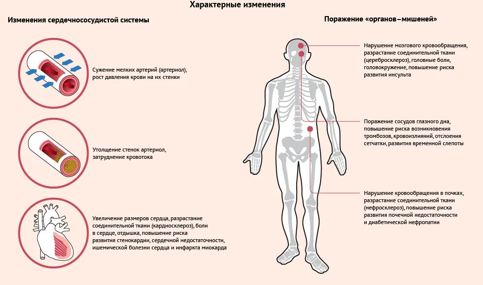 Артериальная гипертензия симптомы заболевания. Гипертоническая болезнь и артериальная гипертензия симптомы. Симптомов характерны для артериальной гипертензии. Органы-мишени при артериальной гипертензии.