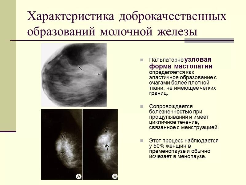 Фиброаденома Узловая мастопатия молочной железы. Узловая мастопатия молочной железы клиника. Узловая форма мастопатии на УЗИ. Доброкачественное образование в молочной железе. Локальное опухоль