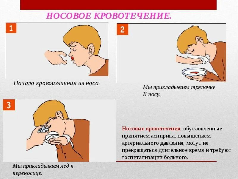 Носовое кровотечение первая помощь. Оказание первой помощи при носовом кровотечении у детей. Кровотечение из носа что делать первая помощь. Носовое кровотечение первая. Частая кровь из носа