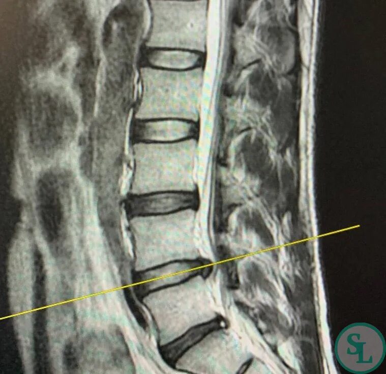 L4 l5 отдел позвоночника протрузия. Межпозвонковые диски l4/l5 l5/s1. Кт межпозвонкового диска l5—s1. Грыжа диска l4-l5. Протрузия l4-5 позвоночника.