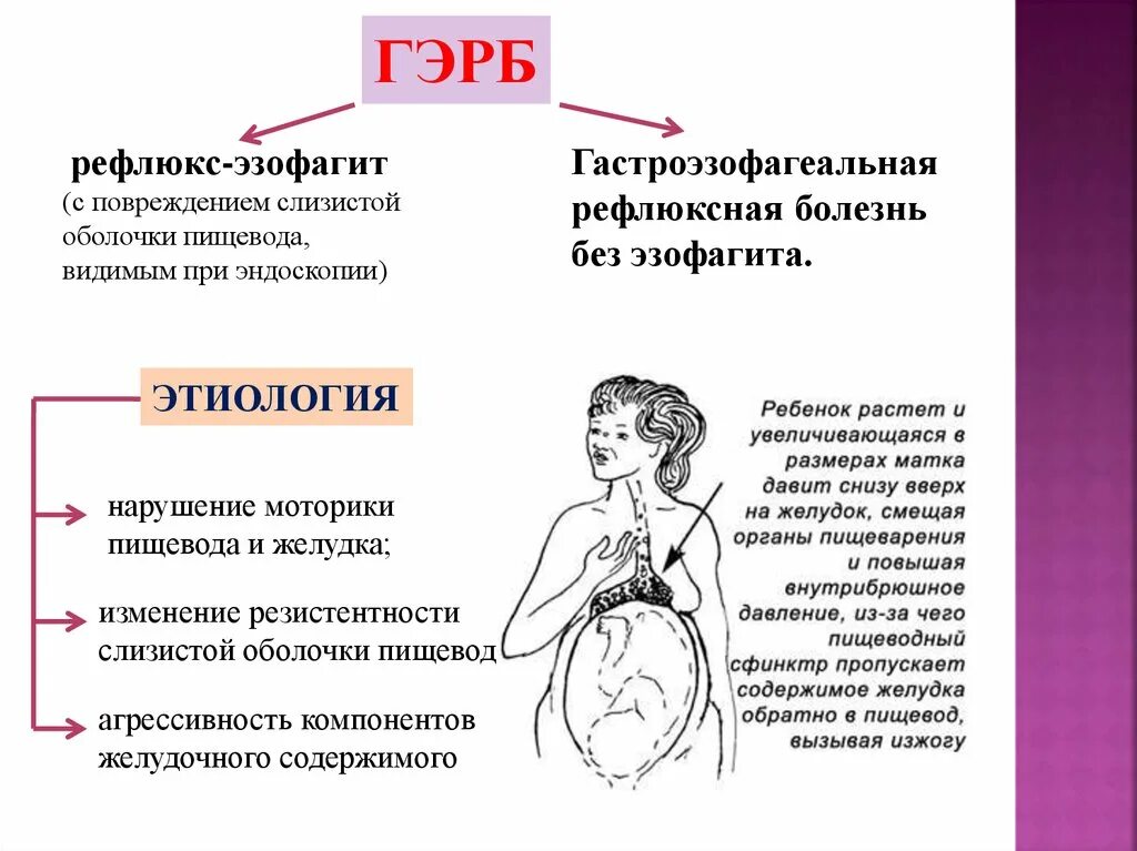 Газоэзофагальнаярефлюксная болезнь. Заболевание органов пищеварения у беременных. Гастроэзофагеальный рефлюкс без