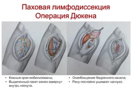 Удаление лимфатического узла операция