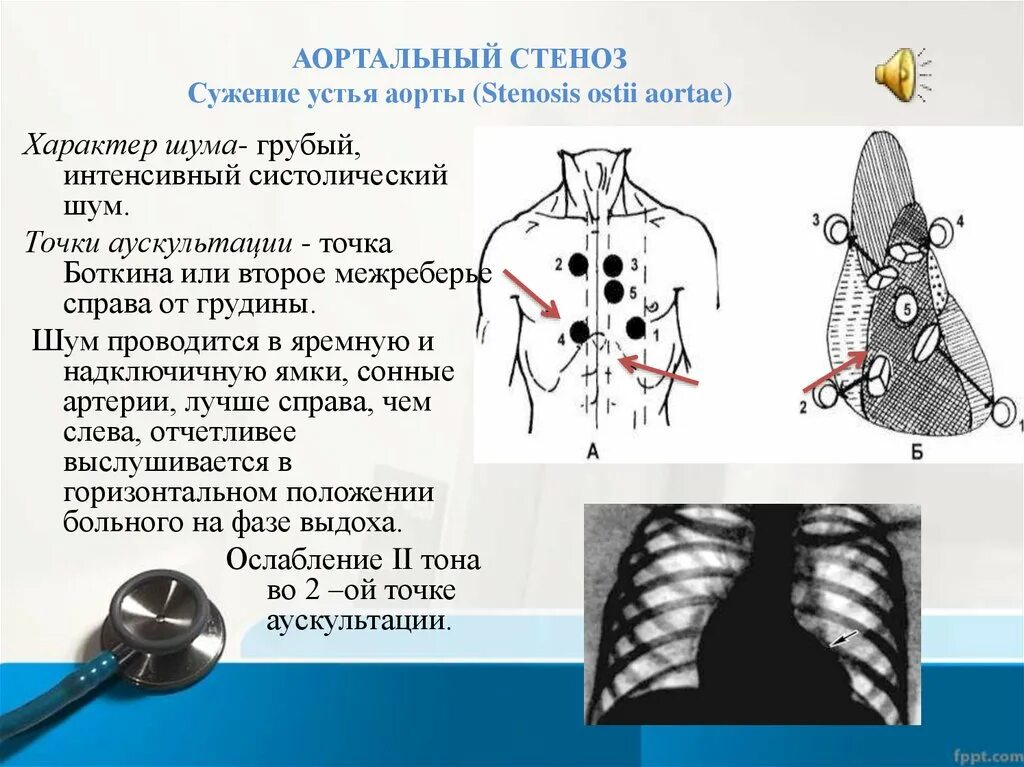 Точки устья. Аортальный стеноз точки аускультации. Систолический шум во 2 точке аускультации. АОРТАЛЬНВЙ стеноз аксеклттауия. Аускультация при аортальном стенозе.